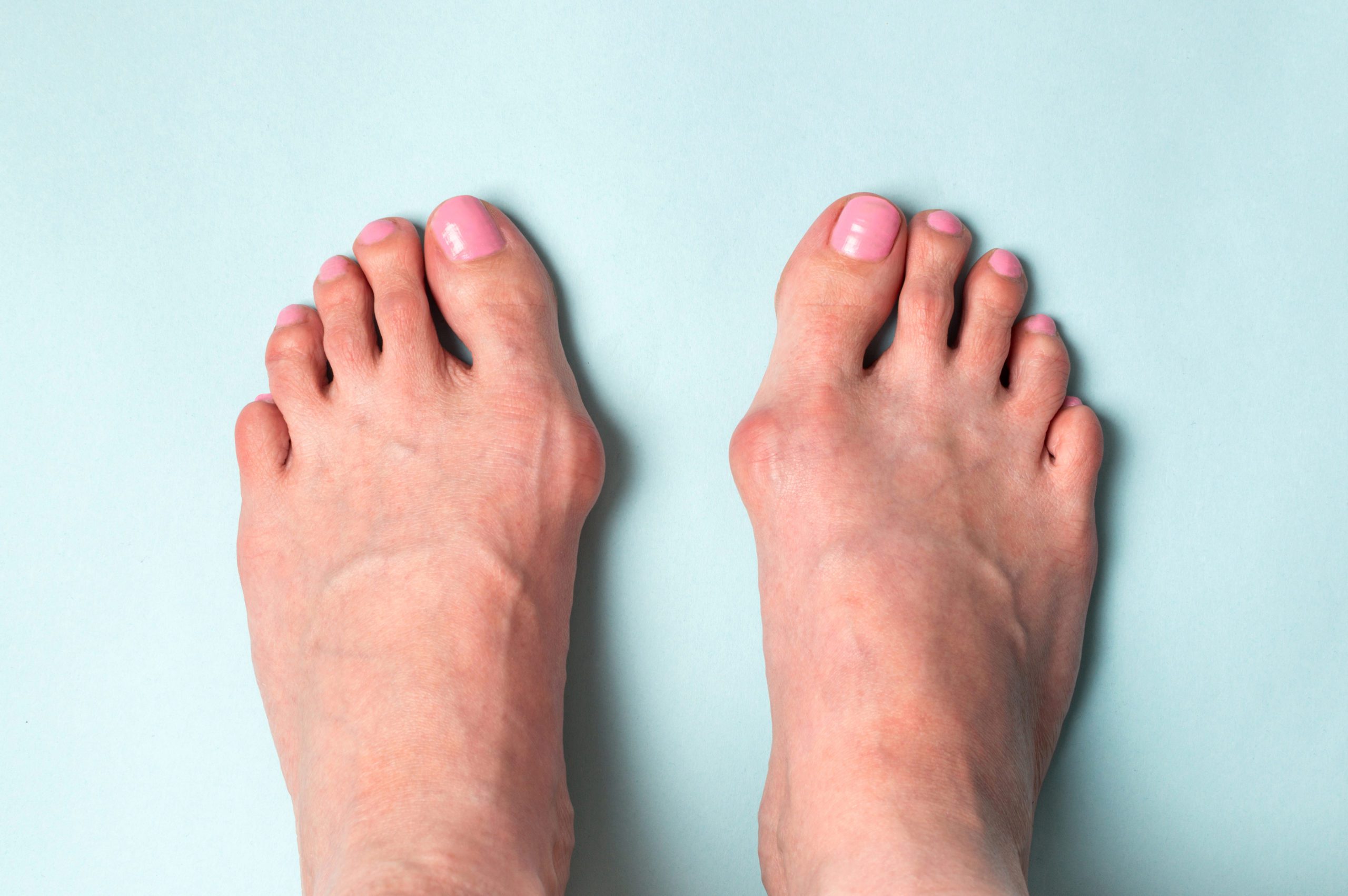 Two feet with visible bunions on the joints at the base of the big toes.