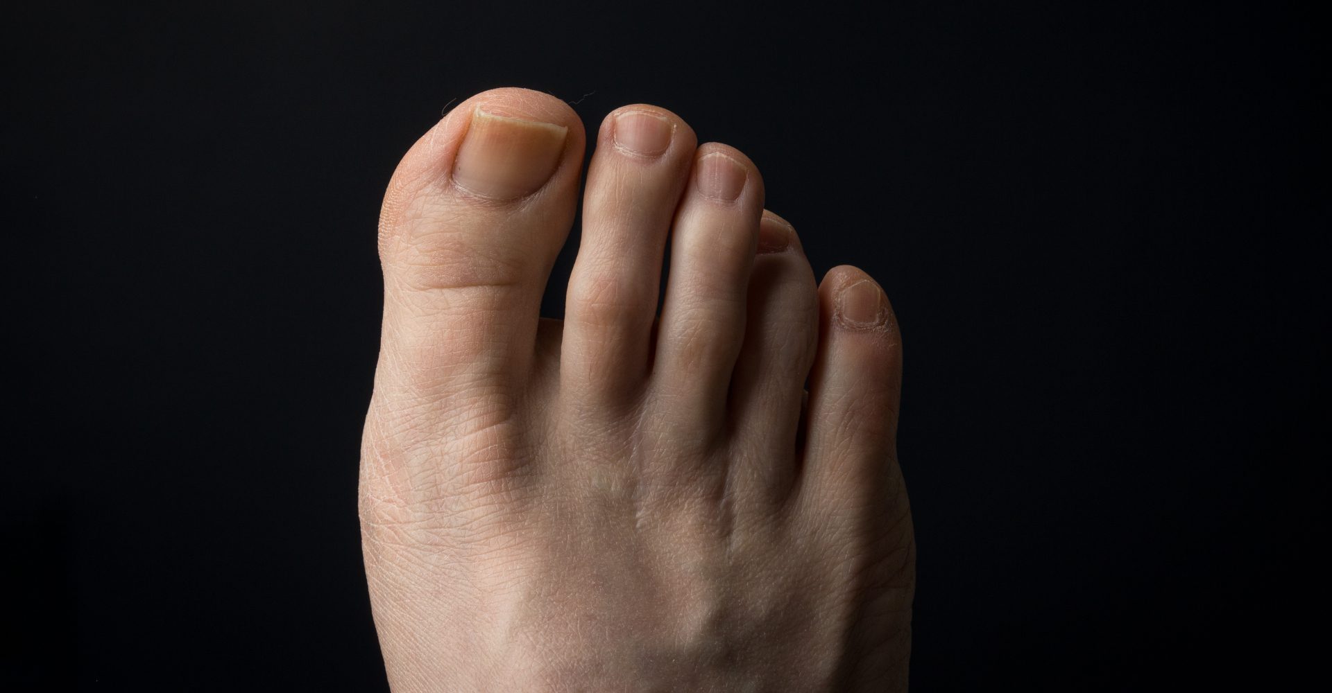 A close-up image of a foot with morton's neuroma, a painful condition affecting the nerve between the toes.