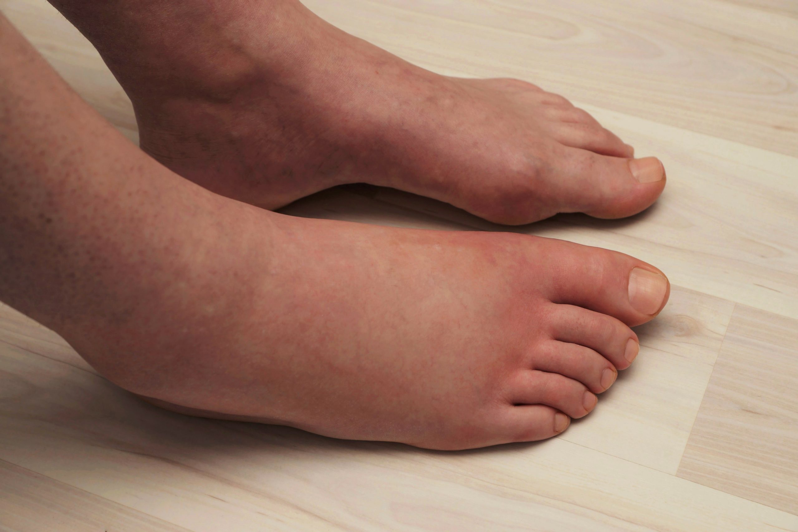 A pair of swollen feet in a pair of comfortable shoes, indicating the importance of finding the right footwear for individuals with swollen feet and ankles.