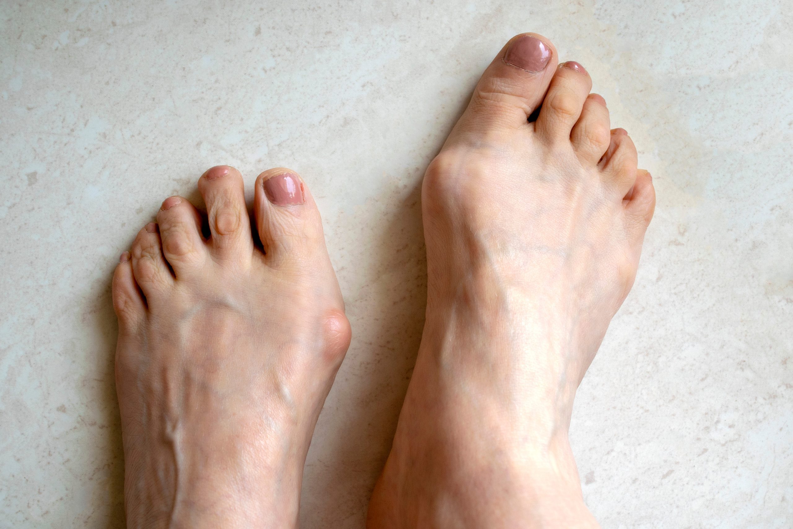 A pair of feet suffering from hallux rigidus and a visible bunion. The big toe is angled towards the other toes, indicating hallux rigidus and a large bony protrusion can be seen at the base of the big toe, indicating a bunion.