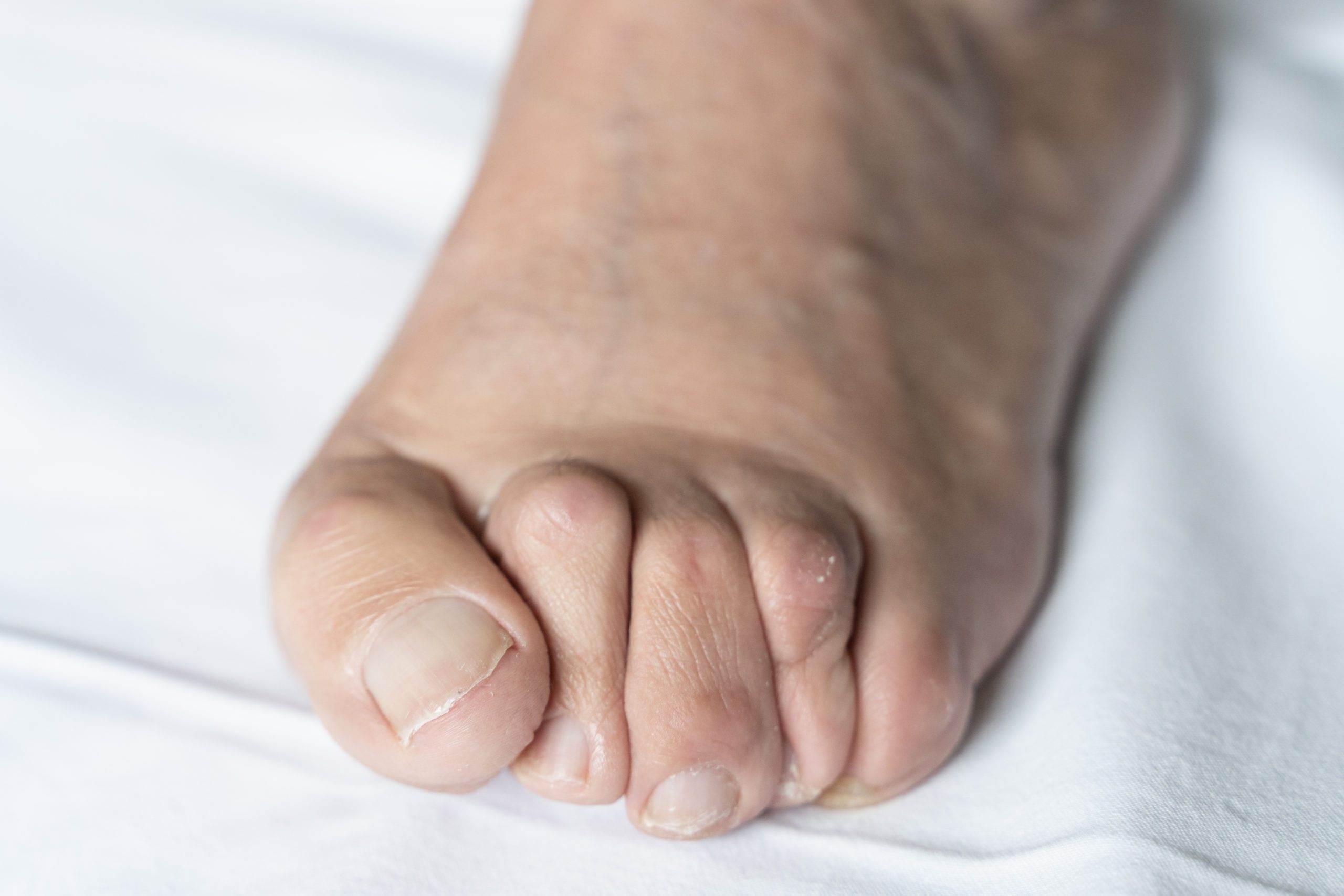 Close-up image of a foot with hammer toes, showing bent and misshapen toes.
