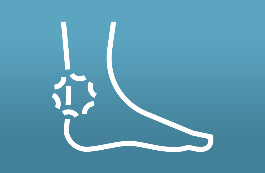 An illustration of a foot with a pain marker on the Achiilles tendon.