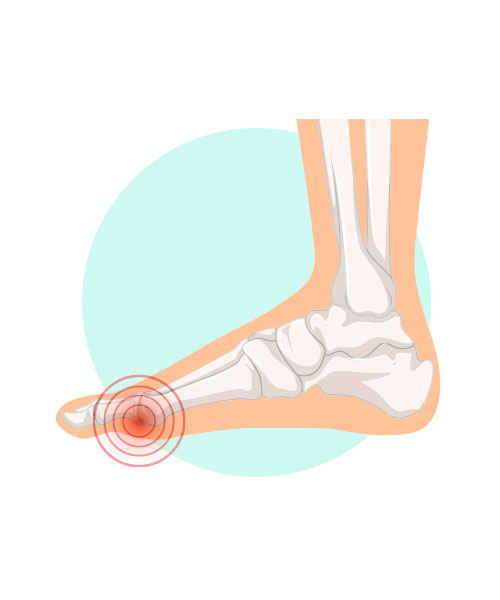 An illustration of a foot indicating a bunion.