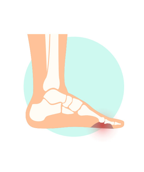 An illustration of a foot with a deep ulcer.